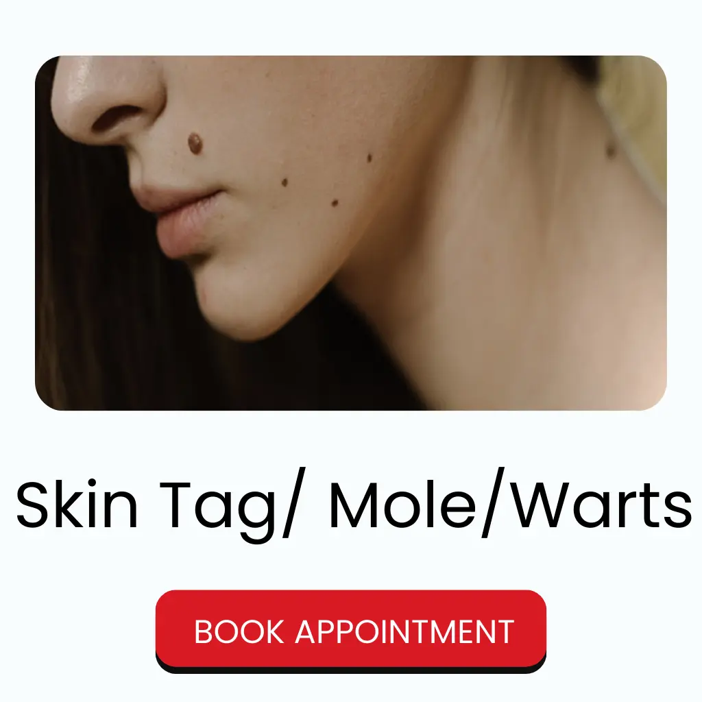 Skin Tag, Mole, and Wart Removal at Best Skin Clinic in Durgapur - Dr. Paul’s Aesthetic Clinic